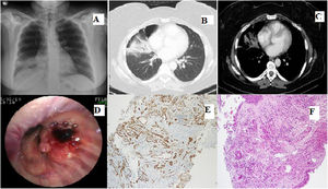 (A) Radiograph showing increased opacity in the right lower zone. (B and C) CT scan showing the mass and pneumothorax area. (D) Groups of neoplastic cells lined with atypical neoplastic cells with vasoformative properties, showing infiltrative growth through normal structures (H&E, 100×). (E) Malignant endothelial cells showing positive staining with CD31 (100×).