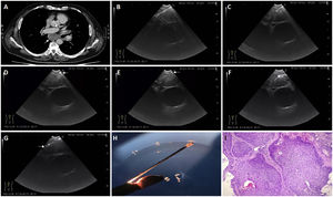 (a) CT showing an enlarged subcarinal lymph node localized by EUS-B. (b) EUS-B image showing the 22-G needle (SonoTip TopGain; Medi-Globe) inside the lymph node. (c–e) We perform 10–12 passes shortening from distally to proximal the length of the needle to create a pathway with the aim of breaking the mucosa, submucosa, and the lymph node capsule. (f) Broken lymph node capsule prior to introduce the 1.1mm cryo-probe (Erbecryo 20402-401). (g) EUS-B image showing the tip of the 1.1mm cryo-probe within the lymph node. (h) Pentax EBUS scope (EB-1970UK) with 1.1mm cryo-probe in the working channel. The tip of the probe has the lymph node tissue obtained by cryobiopsy. (i) Microscopic image of cryobiopsy (10×) showing a well-preserved architecture compatible with squamous cell lung carcinoma.