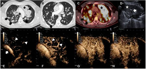 (A) Chest CT scan in lung window. Extensive consolidation in the left upper lobe (star) and multiple bilateral pulmonary nodules (arrows). (B) Chest CT scan in lung window showing suture material from atypical resection for biopsy (arrow). (C) PET-CT: mediastinal window. Increased FDG uptake in left upper lobe (star) and in multiple pulmonary nodules (black arrows). (D) Ultrasound: consolidation in left upper lobe (star) and air bronchogram (arrow) are shown. (E–H) Contrast-enhanced ultrasound. (E, F) Contrast uptake in pulmonary artery (arrow) and its branches (arrowhead). No parenchymal uptake is observed. (F) Delayed uptake in pulmonary parenchyma, indicating irrigation of the mass from the bronchial arteries.