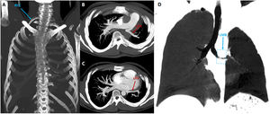 Coronal plane volume rendering (VR) maximum intensity projection (MIP) images (A) reveal 7th cervical rib on the right and rotoscoliosis to the left in the thoracic vertebral axis. Axial plane volume rendering (VR) maximum intensity projection (MIP) sequential CT slices (B and C) show hypoplastic left pulmonary vein and pulmonary artery. Minimum intensity projection coronal CT scan (D) shows superior and intermediate bronchi of three lobes on the right, and a single unbranched bronchus of one lobe on the left and narrowing of the main bronchus. LMB: left main bronchus; LPA: left pulmonary artery; LPV: left pulmonary vein; RCC: right cervical costa.