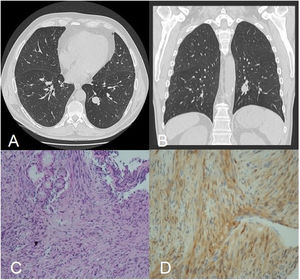 (A, B) Computed axial tomography scan of the thorax, axial and coronal views showed a round, well delineated, 2.2cm nodule in the posterior segment of the left lower lobe. (C) Lung biopsy (haematoxylin and eosin stain; ×10) fusocellular and fasciculated stromal proliferation that traps pre-existing mucous-secretory glands. Characteristic histological features include cellular Antoni A. (D) Tumour cells were immunoreactive to S100.