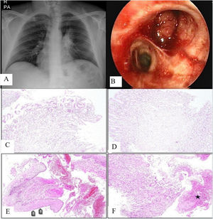 (A) Chest X-ray of the patient on admission. (B) Fibreoptic bronchoscopy revealed endobronchial lesion obstructing the upper lobe of the left lung. (C and D) Chronic inflamed pyloric type gastric mucosa in a bronchoscopic biopsy specimen (H&E, ×100). (E) Areas of focal squamous metaplasia (arrows) in a repeated biopsy sample from the same patient from the same site (H&E, ×100). (F) Samples of inflamed gastric mucosa as well as ulcer surface and floor (area marked with an asterisk) (H&E, ×100).