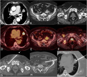 (A) Axial CT image (lung window) shows a suspicious lung nodule in the left upper lobe (asterisk). (B and C) Axial CT images show an ill-defined left retroperitoneal mass (B, asterisk) and an enlarged right lymph node (C, arrow). (D–F) Axial fused PET/CT images corresponding to lesions shown in A–C, respectively, show intense FDG uptake by the left upper lobe lung nodule but mild FDG avidity by the retroperitoneal lesion and inguinal lymph node. (G–I) Axial CT images show the needles targeting the enlarged right inguinal lymph node (G), the left retroperitoneal lesion (H), and the left upper lobe nodule (I), respectively. The duration of the triple lung biopsy procedure was 54min (time elapsed between the acquisition of the first CT scout and the last series acquisition), and the patient was discharged 6h following the procedure.