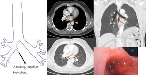 Accessory cardiac bronchus (Orange arrows. Diagram and computed tomography pictures). In bronchoscopy picture: blue star: intermediate bronchus. Green star: accessory cardiac bronchus.