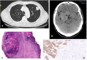 (a) Thorax CT axial contrast-enhanced: 33mg lung spiculated mass located in the upper left lobe contacting and thickening the visceral pleura (T2a). (b) Cranial CT axial, unenhanced: large right-sided extra-axial mass of 55mm, hyperdense, compressing right cerebral peduncule and closely related to arterial vascular structures. (c) HE stain 10×; poorly delimited basaloid cell nodule with areas of necrosis over a proliferation of spindle cells corresponding to meningioma (squamous carcinoma). (d) Immunohistochemistry P40 100×; epithelial cells from squamous carcinoma show P40 nuclear positivity while spindle meningeal cells are p40 negative.