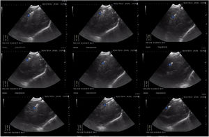 EBUS image showing the 1.1mm cryo-probe inside the station 7 lymph node. By performing the fanning technique, we were able to accurately place the cryo-probe in multiple zones of the lymph node.