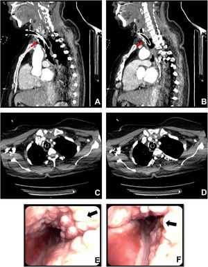 In the antero-lateral tracheal wall, thorax CT scan shows calcified nodules, which protrude into the airway (A–D, red arrows). Large nodules, above the tracheal cannula cuff, are in contact with the cannula itself and occluding the tracheal lumen (B). Bronchoscopy reveals firm and glossy nodules with intact mucosa layer (E and F, black arrows), the posterior tracheal wall is spared.