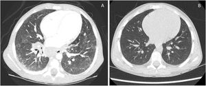 (A) Thoracic tomodensitometry at the diagnosis: ground-glass opacification of both lung parenchyma, predominant in the inferior right lung, micronodules of both lung parenchyma. (B) Thoracic tomodensitometry after 3 months of treatment: near-normalization of both lung parenchyma.