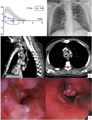 (a) Spirometry and chest X-ray; (b) computerized thoracic tomography; (c) bronchoscopy. *The tumor: a subtle lump on the tracheal wall.