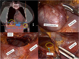 (A) Positron emission tomography scan shows a right paracardiac mass (circle 1) and other mass in anterior left costo-phrenic angle (circle 2) and the retrosternal dissection pathway (blue lines and blue arrow). (B) Right paracardiac mass dissection by right videothorcoscopic approach. (C) Retrosternal pathway under xiphoid process. (D) Left mass dissection by right videothorcoscopic approach.