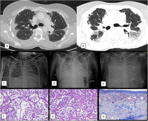 (A) Non-contrast thoracic CT scan that shows pleural thickening and irregular apical opacities as well as traction bronchiectasis suggestive of pleuroparenchymal fibroelastosis (diagnostic CT, two years before referral to a transplant center). (B) Contrast-enhanced thoracic CT scan that reveals progression of the images consistent with pleuroparenchymal fibroelastosis in the upper lobes as well as ground glass opacities and consolidation on the lower lobes, suggestive of diffuse alveolar damage (CT performed during acute exacerbation). (C) Chest X-ray, antero-posterior (AP) projection. First day of ECMO weaning attempt. Patient had been weaned from mechanical ventilation several weeks before. X-ray reveals mild bilateral pulmonary opacities and consolidation of the upper pulmonary lobes consistent with PPFE. Femoral and jugular ECMO cannulas and tracheostomy tube are also identified. (D) Chest X-ray, antero-posterior (AP) projection. Third day of ECMO weaning attempt. Patient had been weaned from mechanical ventilation several weeks before. Thoracic X-ray shows an increase in pulmonary opacities with consolidation in the lower pulmonary lobes and the PPFE pattern. (E) Fifth day after ECMO weaning attempt (weaning attempts ceased on day three). Thoracic X-ray shows a diffuse pattern of severe bilateral consolidation (white lung pattern). (F) Autopsy sample of lung (H/E staining, 20× magnification) reveals presence of hyaline membranes and neutrophilic inflammation in the alveoli with disrupted epithelium, compatible with diffuse alveolar damage in exudative (acute) stage. (G) Autopsy sample of lung (H/E staining, 20× magnification) shows thickening of the alveolar septa, in addition to proliferation of type II pneumocytes and myofibroblasts, compatible with diffuse alveolar damage in proliferative (subacute) stage. (H) Autopsy sample of lung (trichrome staining, 20× magnification) shows marked pleural thickening with fibrosis with abundant collagen deposition.