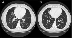 (A, B) Computed tomography images showing bilateral bronchiectasis and bronchiolectasis predominantly in the middle fields and lower lobes of both hemithoraces. Other findings included distal branched images and centriacinar nodules measuring around 1mm, associated with distal airway involvement.