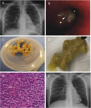 (A) Chest X-ray in 2017 showing left lower lobe opacity (prior to the first bronchoscopy). (B) Bronchial cast occluding left lower lobe visualized with the flexible bronchoscope. (C and D) Bronchial cast extracted with forceps. (E) Many inflammatory cells, predominantly eosinophils with Charcot-Leyden crystals (arrows). (F) Chest X-ray in 2023 showing small retrocardiac opacity.