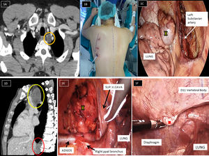 (A) Axial contrast-enhanced computed tomography image of the chest shows a left posterior mediastinal mass (orange circle), between trachea and left subclavian artery. (B) This picture shows the patient position in prone and the thoracoscopic ports placed. (C) Left posterior mediastinal mass (yellow cross) dissection by left VATS in prone. (D) Sagittal contrast-enhanced computed tomography image of the chest shows a right paratracheal mass (yellow circle) behind to superior vena cava and the paravertebral mass (red circle). (E) Right paratracheal mass dissection (yellow cross) by right VATS in prone. (F) Right paravertebral mass dissection (red cross) by right VATS in prone.