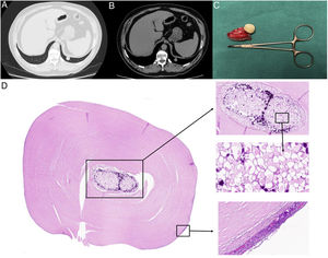 (A) Axial CT section at T12 level in parenchyma window; (B) soft tissue window; (C) lung resection piece; (D) hyalinizing granuloma. In the center of the image, a foreign body (FB) of probable plant origin is observed, with calcified foci, encompassed by abundant fibrocollagenous tissue arranged in a laminar manner around it. In the periphery of the lesion, dilation of vascular spaces is identified, as well as a slight inflammatory reaction with the presence of lymphocytes and plasma cells.