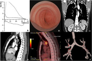 (A) Morphology of the spirometric curve with inspiratory and expiratory plateau. (B) Distal tracheal stenosis seen in fibrobronchoscopy. (C and D) Chest CT with lobulated soft tissue mass, at the level of the distal third of the tracheal lumen, which conditions partial stenosis. (E) Mediastinal lesion with pathologic metabolism. (F) Chest CT reconstruction showing tracheal stenosis.
