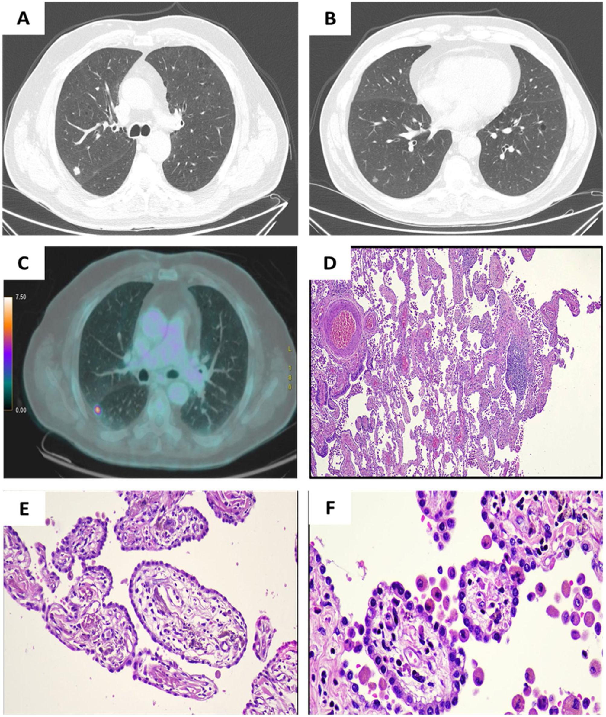 Rul Rul Placental Transmogrification of the Lung Associated With Pulmonary ...