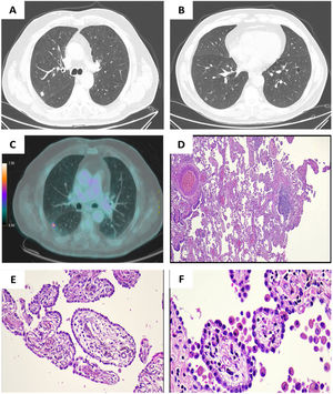 (A) 11mm solid nodule in RUL. (B) 7mm subsolid nodule in middle lobe. (C) Hypermetabolic uptake in RUL with a maximum standardized uptake value (SUV) of 10.38. (D) TPL (E) Low-power magnification of placental transfmogrification showing villi-like proliferation destroying normal lung architecture, Hematoxylin-Eosin [ HE] x4. (F and G) Intermediate and high-power magnification showing papillary structures resembling placental villi, lined by cuboidal epithelial cells and containing myxoid-edematous or fibrotic stroma, with a variable number of bland stromal cells, proliferating vessels and inflammatory cells; HEX20.