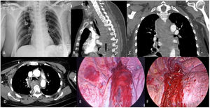 (A) Mediastinal widening visible on chest X-ray; (B) mediastinal hematoma (MH) visible in the sagittal section of the CT; (C) MH visible in the coronal section of the CT; (D) MH visible in the axial section of the CT at the level of T6; (E) video-thoracoscopic view of the MH; (F) video-thoracoscopic view after drainage of the MH. White arrow: azygos vein. Blue arrow: esophagus.
