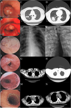 (A and B) A huge pedunculated round mass in the inferior third of the trachea (20/3/2015). (C and D) Right lung tumor before and after receiving argon-helium cryoablation targeted therapy (30/10/2020; 4/11/2020). (E and F) Esophageal stenosis, and then esophageal covered metal mesh stent (MTN-SE-S-20/100-A-8/650) implantation under DSA (5/1/2021; 6/1/2021). (G and H) Tracheal space occupying, esophageal space occupying after esophageal covered metal mesh stent implantation (7/6/2023). (I and J) Rigid bronchoscopy combined with flexible bronchoscopy to remove the new organisms in the esophagus and then move the esophageal covered metal mesh stent up 1cm(7/6/2023). (K and L) Rigid bronchoscopy combined with flexible bronchoscopy to remove tracheal new organisms and then Y-shaped covered metal mesh stent (size: 16mm×50mm trachea/12mm×35mm left principal bronchus/15mm×35mm right principal bronchus) was implanted (7/6/2023; 9/6/2023). (M) Chest CT was used to evaluate the placement of double stents (10/6/2023). (N) Digestive-respiratory tract fistulas (8/7/2023).
