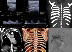 (A) Doppler ultrasound of the right thoracic wall identifies prominent right-sided intercostal arteries showing spectral broadening (increased peak systolic velocity [134 cm/s] and decreased resistance index [0.53]), suggesting an arterial fistula with an increased and turbulent blood flow. (B) Doppler ultrasound of the left thoracic wall shows a normal doppler waveform of the intercostal arteries (low peak systolic velocity [27 cm/s] and high resistance index [0.84]). (C) Coronal thoracic maximum intensity projection (MIP) CT image shows hypertrophy of the right superior intercostal arteries (arrows) compared to the left hemithorax. (D) Coronal thoracic MIP CT image shows an unexpected early and prominent contrast enhancement of the right upper lobe vessels (asterisks) due to retrograde filling through the hypertrophied intercostal arteries. (E) Volumetric reconstruction CT image shows the hypertrophy of the posterior right intercostal arteries. (F) Digital subtraction angiogram shows the right intercostal arteries embolization procedure using polyvinyl alcohol particles (300–500 μm in size).