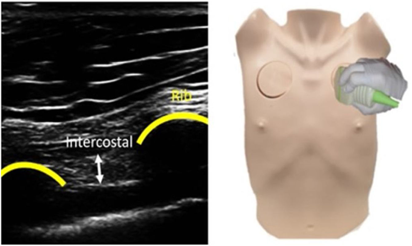 Ultrasound in the Study of Thoracic Diseases: Innovative Aspects ...