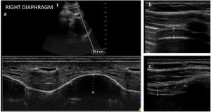 (a) Ultrasound assessment of diaphragmatic mobility in B-mode and M-mode. Calculation of diaphragmatic excursion: line from the end of expiration to the maximum of the inspiratory curve. (b) Thickness measurement with a linear probe at the end of inspiration and (c) at the end of expiration.