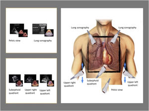 Primary thoracic ultrasound windows in UCIR.