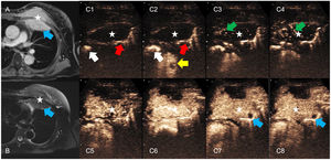 Actinomycosis of the lung with involvement of the left chest wall. (A) T1-weighted chest MRI after intravenous gadolinium administration. (B) T2-weighted thoracic MRI with fat suppression. (C) Contrast-enhanced ultrasound images after 4s after injection (C1), 6s (C2), 10s (C3), 14s (C4), 20s (C5), 36s (C6), 45s (C7) and 60s (C8). The images show a voluminous lung lesion with extensive involvement of the chest wall (white star) showing absence of early enhancement after administration of ultrasound contrast (C1 and C2), despite evidence of uptake in the adjacent parenchyma (red arrows) and within the right (white arrows) and left ventricles (yellow arrow). The lesion shows arterial supply from chest wall arteries (green arrows) and progressive homogeneous uptake in the systemic arterial phase together with slow washout. A small area of necrosis can be seen in the pulmonary part of the infection (blue arrows).