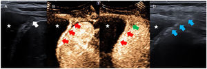 Pleural tuberculosis. (A) Conventional chest ultrasound showing left pleural effusion (white star) and irregular thickening of the diaphragmatic pleura (white arrow). (B) Contrast-enhanced ultrasound 20s after injection showing uptake of the irregular thickening of the diaphragmatic pleura and lateral costophrenic sinus (red arrows) which is more evident than in the conventional scan. (C) Contrast-enhanced ultrasound 45s after injection showing some washout of contrast (red arrows) and some focus of necrosis within the pleural thickening (green arrow). (D) Ultrasound-guided pleural biopsy showing the needle (blue arrows) pointing towards the diaphragmatic pleural thickening.