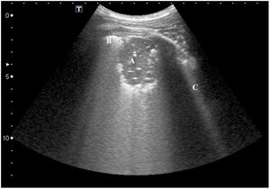 Infectious consolidation. Chest ultrasound performed with a convex probe and in longitudinal projection showing infectious consolidation in contact with the chest wall and the presence of air bronchogram inside (A), pleural line (B) which is abruptly interrupted by the presence of consolidation and an increase in B-lines (C).