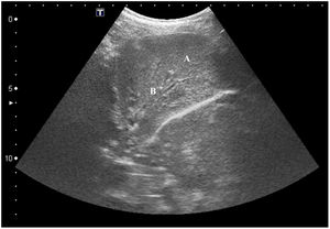 Atelectasis of obstructive origin. Thoracic ultrasound performed with a convex probe and in transverse projection showing homogeneous and hypoechogenic consolidation (A) with the presence of anechogenic lines in its interior, branched (B) and without colour Doppler signal called fluid bronchogram sign.