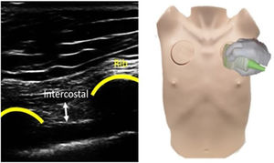 The figure shows a B-mode ultrasound of the parasternal intercostal muscle. The position of the probe is in the parasternal space between the 2nd and 3rd ribs. The intercostal muscle is located between two ribs, cranial to the pleural line and behind the pectoralis muscle.