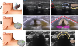 (A) Longitudinal assessment, superior with linear probe. Cranially we find the thyroid cartilage (red), posteriorly the cricoid cartilage (blue), between the two the crico-thyroid membrane. Caudally we find the tracheal rings (yellow) and just above them the thyroid isthmus (shaded orange). (B) Transversal assessment, upper with linear probe. The thyroid cartilage (red) is found in the most superficial area, followed by the vocal cords (over-surrounded) and in depth by the arytenoid cartilage (pink). (C) Transverse assessment, lower with linear probe. The double yellow line represents the trachea. The oesophagus is shaded in the posterior area, but does not differentiate the double hyperechogenic line. If a double line is visible at oesophageal level, we must consider that the orotracheal intubation has not been performed correctly. Image created by the author.