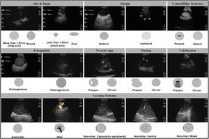 Ultrasonographic features during EBUS used to differentiate metastatic adenopathies from those of reactive origin: size, axis (long axis/short axis), shape (oval/round), margin (clear/not clear), central hilar structure (present/absent), echogenicity (homogeneous/heterogeneous), necrosis (present/absent), conglomeration (present/absent), calcification (present or absent), vascular pattern (avascular/hilar/non-hilar/capsular/centrally, mixed). Rounded shape, absence of central hilar structure, presence of conglomerate and non-hilar vascular perfusion pattern may predict lymph node metastasis.