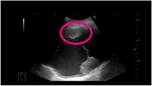 The area marked on the chest ultrasound corresponds to pleural thickening and indicates the site for pleural biopsy.