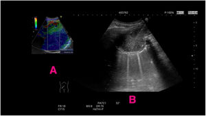 Subpleural lung neoplasia. The image on the left (A) corresponds to the application of elastography on the pathological image. The “blue” part indicates the non-necrotic tumour area. In the image on the right (B), the ultrasound guide is directed to the tumour area corresponding to the “blue” colour of the elastography image.
