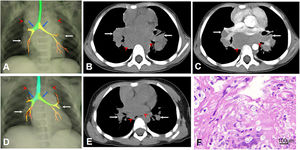 Volume-rendered CT (A) and axial unenhanced images (B) showed multiple swollen and partially fused lymph nodes in the hilar (white arrows) and mediastinal (red arrowheads) areas, with the largest one measuring 5cm×3cm, causing the compression of right and left main bronchus (blue arrows). Axial CT contrast-enhanced image (C) demonstrated slight enhancement of the swollen lymph nodes. At six-month follow-up, chest CT (D and E) showed the shrinkage of lymph nodes and the relief of main bronchus compression. H&E staining (F) demonstrated numerous spherical yeast cells of variable size surrounded by a clear halo (400×), suggesting the diagnosis of cryptococcosis.