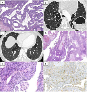 (A) Skin lesion: fibrohistiocytic strain showing vascular structures of varying calibers and pseudocystic cavities with no epithelial or endothelial lining. No pleomorphism or necrosis observed. Suggestive findings of fibrous histiocytoma. (B and C) High-resolution computed tomography of the chest: multiple diffuse and bilateral cystic lesions. Cysts predominantly in upper lobes, random distributed (subpleural and peribronchovascular) with thin and well-defined walls, polylobulated and of irregular size and shape. Bulky lesion containing air–fluid component. (D) Pulmonary cyst biopsy: cyst wall showing congestive thick vessels accompanied by fusocellular proliferation with no atypia, mitosis or necrosis. (E) High magnification image (400×) showing previously described cellular characteristics consistent with fibrous histiocytoma. (F) Immunohistochemical staining corresponding to a fibroblastic–fibrohistiocytic strain, expressing CD10, factor XIII, and CD68 with a Ki67 index <5%.