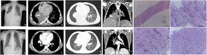 (a) Chest radiograph shows a lung opacity projected in the right lower lung caused by atelectasis of the middle and right lower lobe. (b)–(d) CT post contrast images show a right paramediastinic smooth contour heterogeneous enhancing mass with calcifications (red arrows) measuring 47mm×47mm causing post obstructive atelectasis of the middle and right lower lobe. (e) Chest radiograph one-year pos chemotherapy shows a lung nodule in the right hemithorax adjacent to the right atrium. (f)–(h) CT post contrast images one-year post chemotherapy shows important reduction of the mass size, which is confined to the right hilum. (i) Core needle of a lung inflammatory myofibroblastic tumor is characterized by a proliferation of spindle fibroblastic–myofibroblastic cells with variation in cellularity and stroma and focal inflammatory infiltrate. In the upper right picture, a small lung alveolar space is seen.