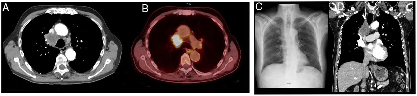 Endobronchial Ultrasound: Detection of Lung Adenocarcinoma and ...