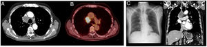 (A and D) Tomography image showing the mediastinal neoplastic mass. (B) PET-Tomography image with uptake in the right paratracheal region. (C) Chest X-ray in posteroanterior view showing mediastinal widening.