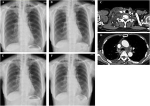 CXR images (A, B, E, and F), contrast-enhanced chest computed tomography images (C and D). (A) Before the initiation of CPAP therapy. (B–D) Two days after the initiation of CPAP therapy. (E) The day after the discontinuation of CPAP therapy. (F) One week after the discontinuation of CPAP therapy. CPAP=continuous positive airway pressure; CXR=chest X-ray.