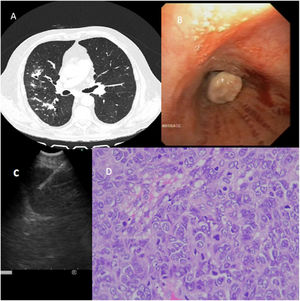 Chest CT, endobronquial tumor, TBNA performed with endobronchial ultrasound (EBUS) and histological image.