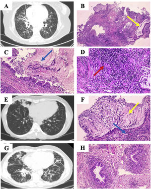 (A) Extensive bilateral bronchiectasis and bronchioloectasis, tarnished glass, septal thickening and. (B) Lung parenchyma with abundant dilated bronchial structures with mucoid material (yellow arrow). (C and D) Intraluminal mucoid material shows intraluminal polymorphonuclear intraluminal polymorphs (blue arrow), and bronchiolar structures are surrounded by a notable lymphocytic inflammatory infiltrate (red arrow). (E) Hiliomediastinal adenopathies (up to 18mm, previously 15mm), bronchiectasis, nodular lesions and ground glass. (F) Bronchial structures surrounded by lymphocytic infiltrate (yellow arrow), mucoid material with presence of neutrophils (blue arrow). (G) Reticulonodular pattern with predominant distribution in bases, paratracheal (12mm) and subcarinal (10mm) adenopathy. (H) Peribronchial lymphocytic infiltrate.