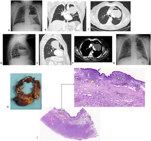 (A) Voluminous cystic formation with air-fluid level content that occupies more than 1/3 of the left hemithorax in the posteroanterior projection of the chest X-ray; (B) CT scan coronal plane, showing the displacement and compression of vascular structures due to the pulmonary cystic lesion; (C) CT scan axial plane at the level of T6; (D) lateral projection of the chest X-ray; (E) CT scan sagittal plane; (F) CT scan axial plane in soft tissue window; (G) chest X-ray performed 5 months after surgery; (H) in the segmentectomy specimen, a unilocular cystic cavity with a maximum diameter of 65mm was recognized, which was focally in connection with a bronchus (red arrow); (I) this cavity was lined by bronchial respiratory type epithelium (blue arrow), with residual smooth muscle fibers (green arrow) and marked underlying chronic inflammation (yellow arrow), characteristic findings of cystic bronchiectasis.