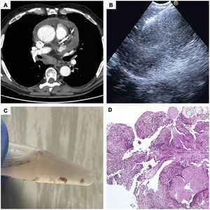 (A) Chest CT-Scan: mild and free pericardial effusion, with circumferential distribution and a large subcarinal lymph node of 48mm. (B) Endobronchial ultrasound view of the opening mini-forceps in the lymph node. (C) Intranodal forceps biopsy samples. (D) Histological intranodal forceps biopsy samples: giant cell granuloma.