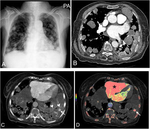 (A, B) Cannonball metastases in both lungs on X-ray and thorax CT. (C) Maximum intensity projection image showing the largest pseudoaneurysm (arrow) and the terminal branches of the pulmonary artery (arrowheads). (D) The color intensity of the pseudoaneurysm indicated by the arrow in the color mapping obtained by thoracic CT fusion is the same as that of the right ventricle (*).