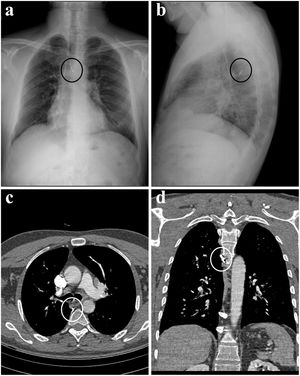 A metallic density foreign body is observed in the posterior mediastinum, adjacent to the esophagus. The circled area indicates the foreign body.