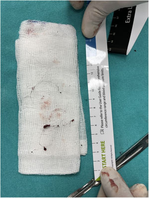 The removed foreign body.